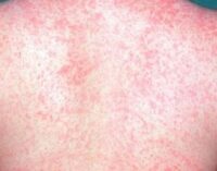 Study: Measles makes your body forget how to fight other diseases