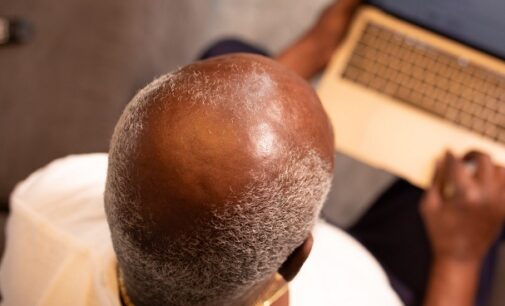 Bald men at greater risk of severe case of COVID-19, study claims