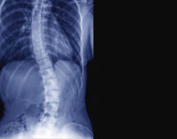 Scoliosis: Living beyond the curve