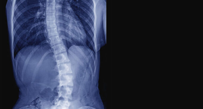 Scoliosis: Living beyond the curve