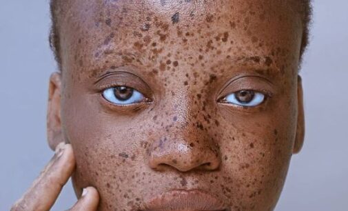 I was rejected and abused over my skin condition, says model