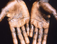 US, Portugal report cases of monkeypox