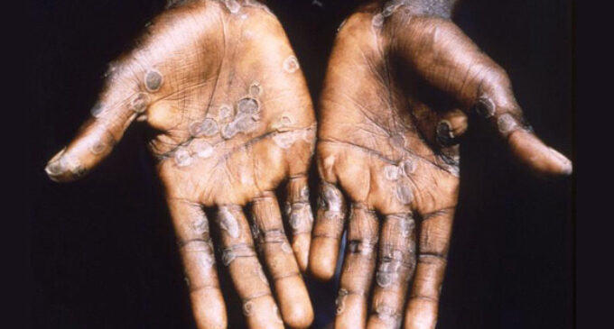 Lagos, Rivers, Delta worst hit as NCDC records 59 suspected monkeypox cases