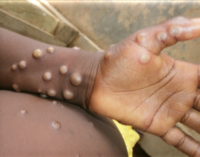 NCDC: 15 monkeypox cases confirmed in 2022