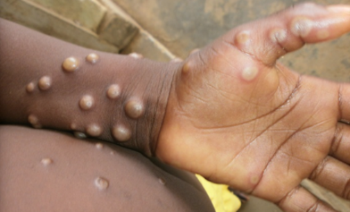 NCDC reports one monkeypox death as cases rise to 157
