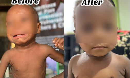 MIRACLE BABIES: How malnourished children are getting a new lease of life