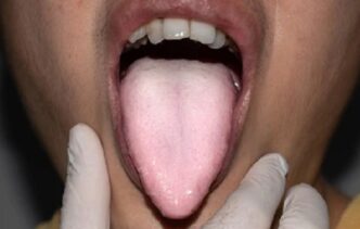 oral thrush