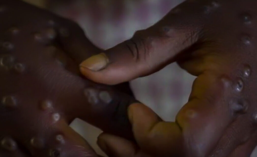 File photo of Monkey Pox (mpox)
